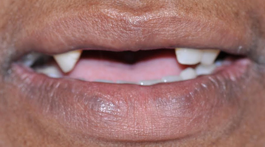 Manhattan dentures
