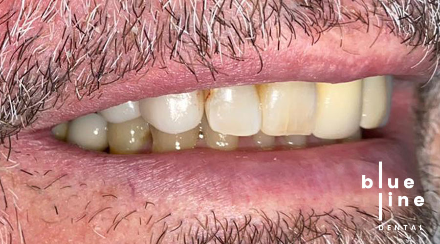 Manhattan dental implants
