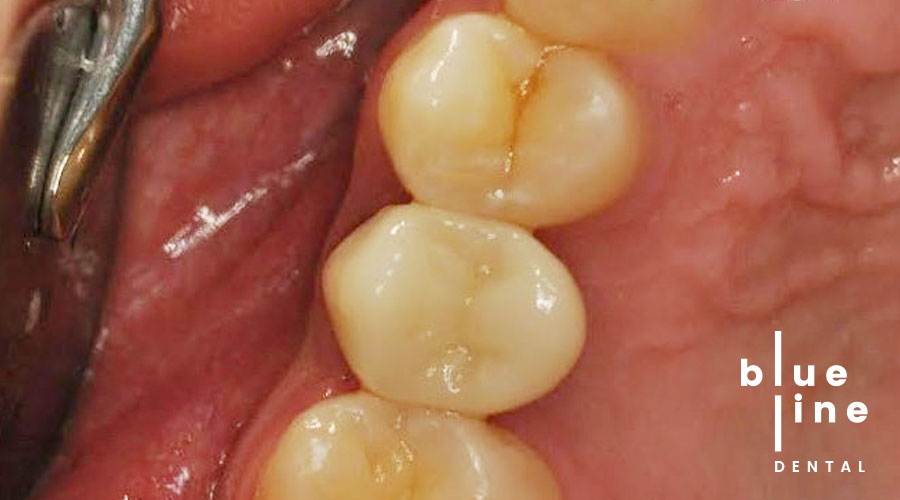 Manhattan NYC dental implants