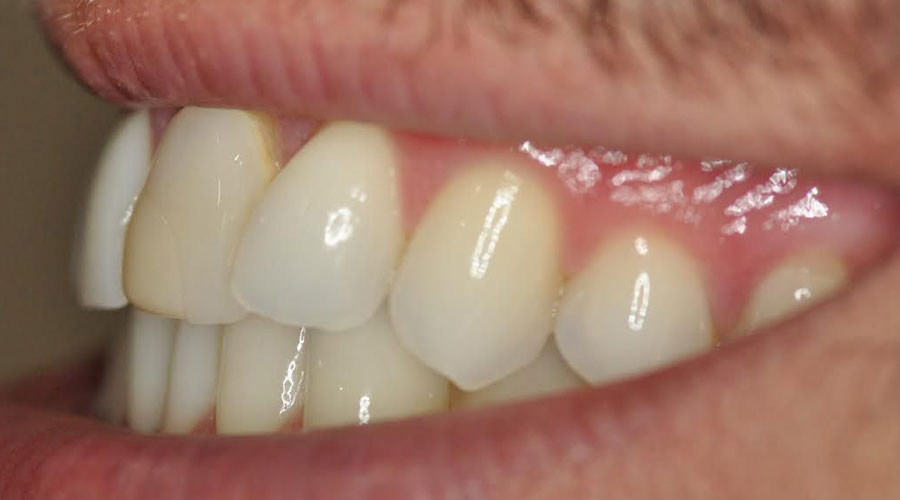 veneers manhattan
