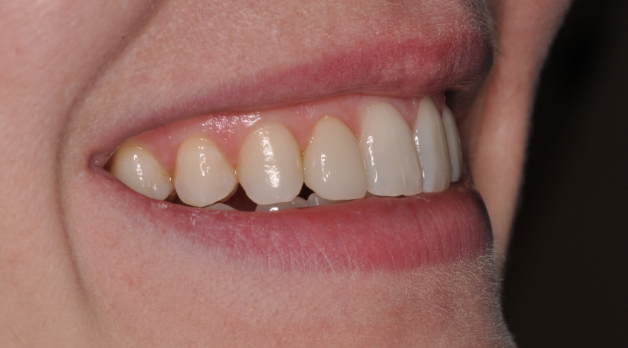 Veneers in manhattan nyc