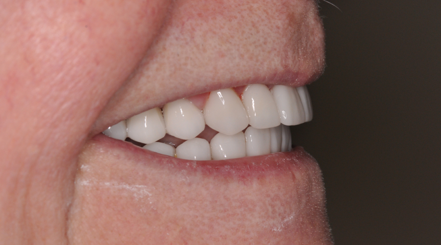 full mouth rehab manhattan nyc
