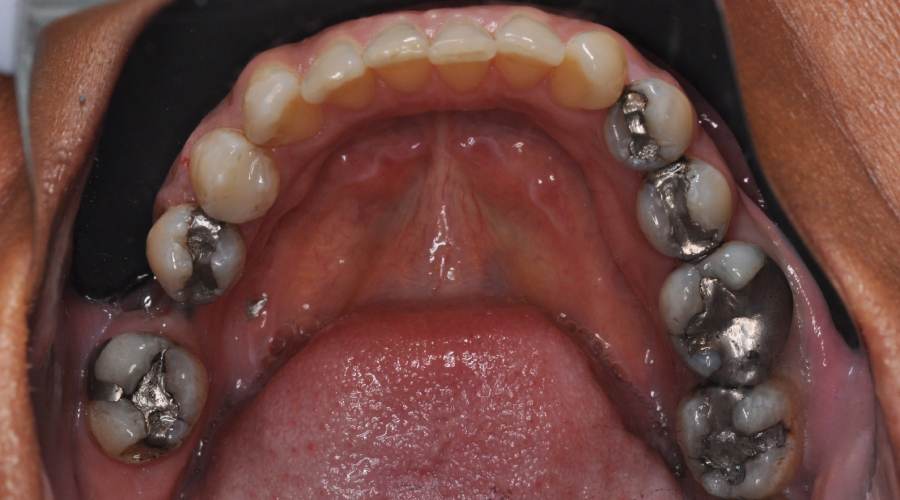 full mouth rehabilitation in Manhattan