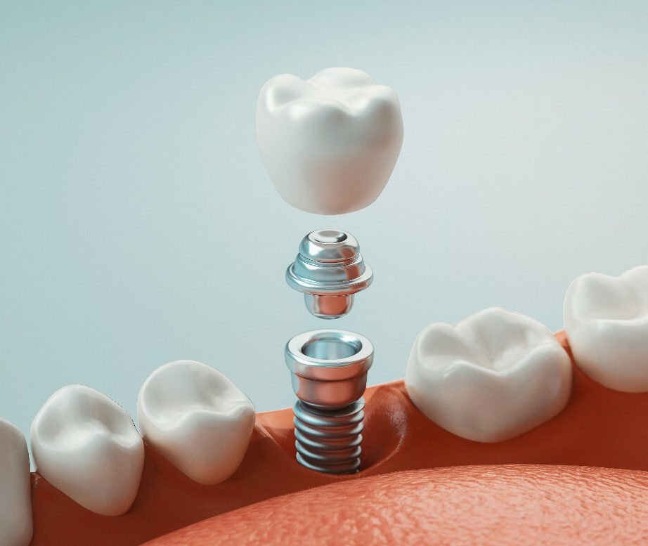 dental implant