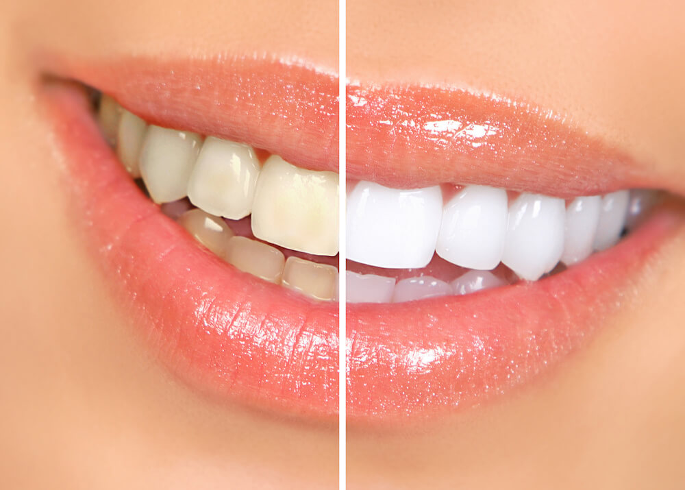 Manhattan teeth whitening