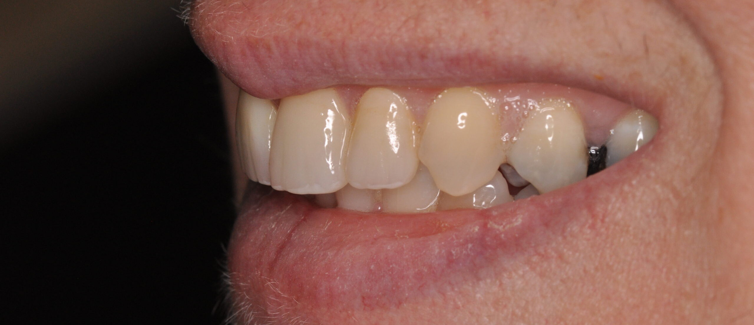 Tooth Repair
