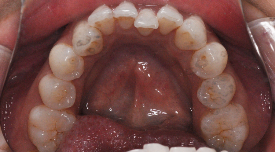 invisalign acclusal lower before
