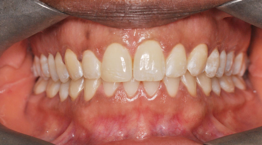 invisalign front after